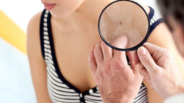 Меланома: ранні прояви раку шкіри